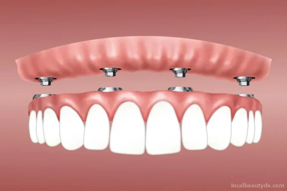 Zahnimplantat München - Implantate - Zahnersatz - 3D-Implantate - Plastische Gesichtschirurgie - Gesichtsverjüngung - Botox, München - Foto 2