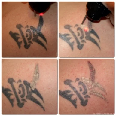 Tattooentfernung Nicole Holtappels, Nordrhein-Westfalen - Foto 4